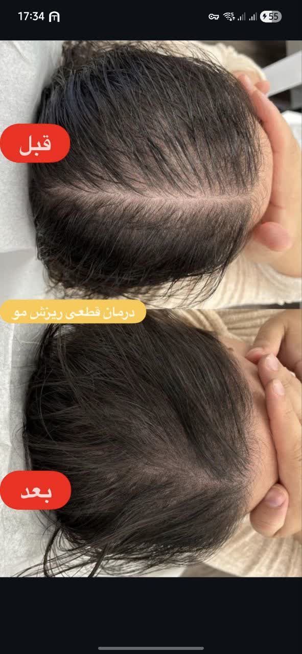 محلول تونیک ضدریزش مو کمک به تجدید ورشد سریع موهای جایگزین با مکانیسم عمل فرمولاسیون ترکیبی برند بیز